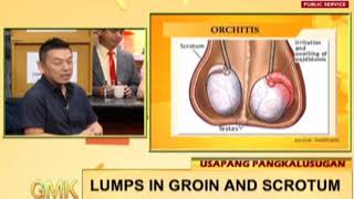ALERT!! Lumps in groin and scrotum | Usapang Pangkalusugan