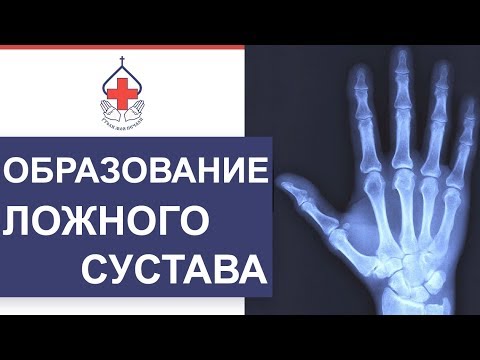 ✋ Последствия перелома ладьевидной кости и уникальные методы лечения. Перелом ладьевидной кости. 12+