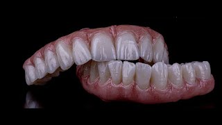 Full Arch Dental Implants vs  Dentures 1080p