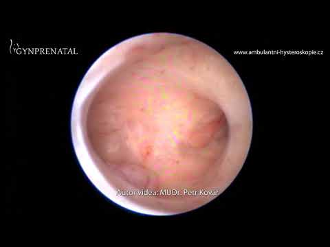 Video: Hysteroskopické Odstranění Polypů Endometria