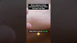 Uncover the Hidden Dangers of Grass Pollen on Your Skin!
