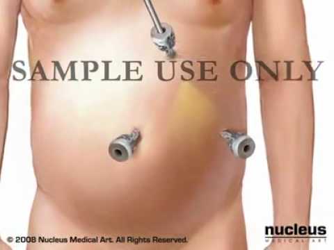 Laparoscopic Colectomy
