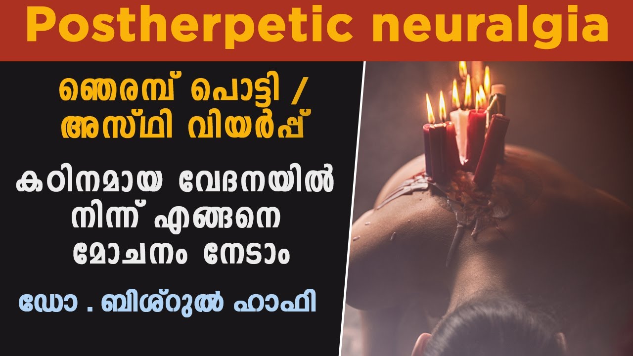 post herpetic neuralgia treatment | Herper Zoster | Chicken Pox Malayalam | Pain Management