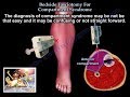 Bedside Fasciotomy For Compartment Syndrome - Everything You Need To Know - Dr. Nabil Ebraheim