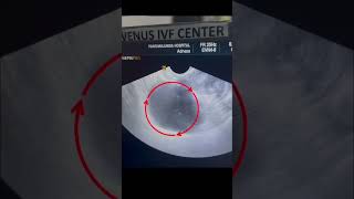 Hydrosalpinx & IVF Success | Why Laparoscopic Salpingectomy Is Important Before Embryo Transfer