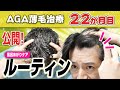 【M字ハゲ】AGA薄毛治療22か月の報告【ハゲ改善日記】