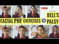 FACIAL PNF EXERCISES IN BELL'S PALSY