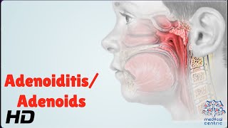 Adenoiditis/Adenoids: Everything You Need To Know