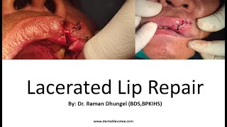 Cosmetic repair of Lacerated Lips - Dr. Raman Dhungel