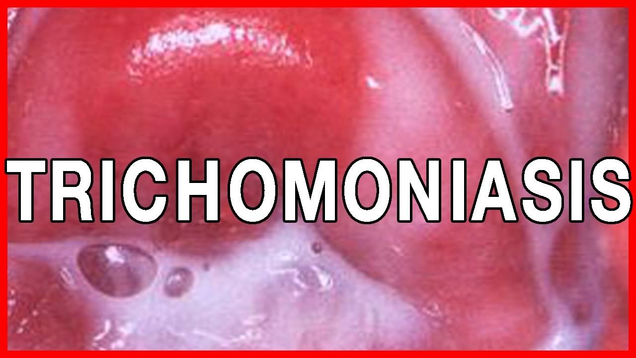 What is Trichomoniasis...