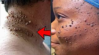 Remove long stay skin tag most effective remedy