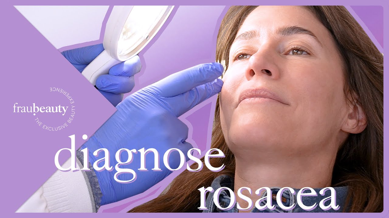 Alles über Rosacea - ...erkennen, behandeln - inkl. Profi-Tipps 💜