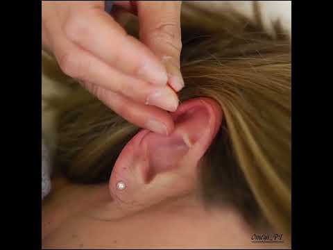  العلاج الصيني عن طريق الوخز بالإبر