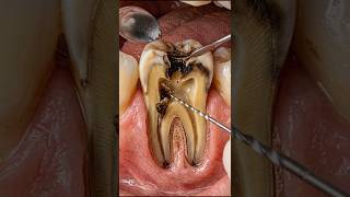 Tooth Decay Removal &amp; Filling – 3D View #shorts