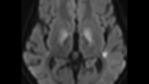 Mitochondrial Deletion