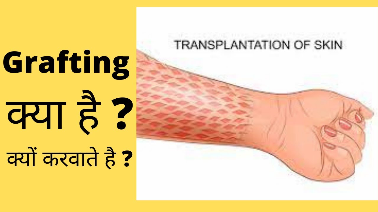 what is skin grafting / skin grafting / skin grafting in hindi / full