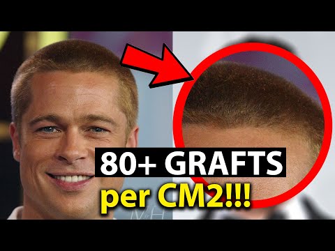 Brad Pitt Hair Density after Hair Transplant Possible!? 80+ Grafts per cm2