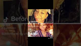 Before & After Surgery Dr. Michael Obeng