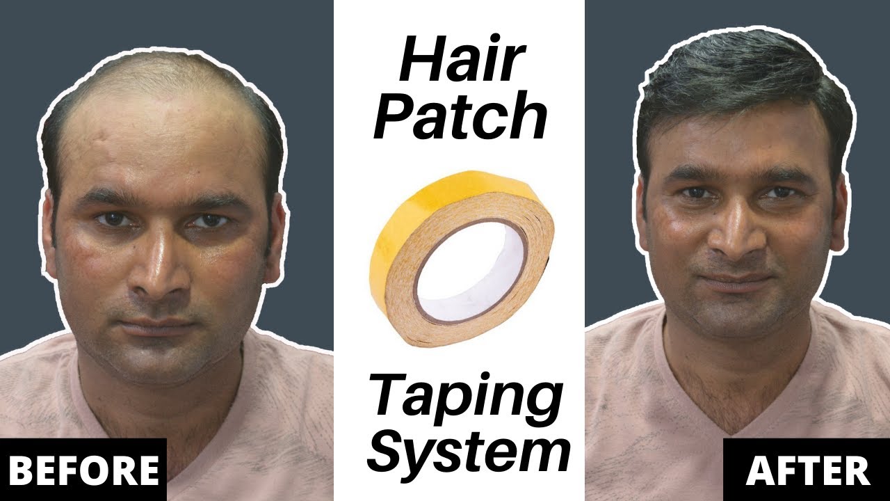 Hair Patch Taping System. Taping method in hair patch. Side partition