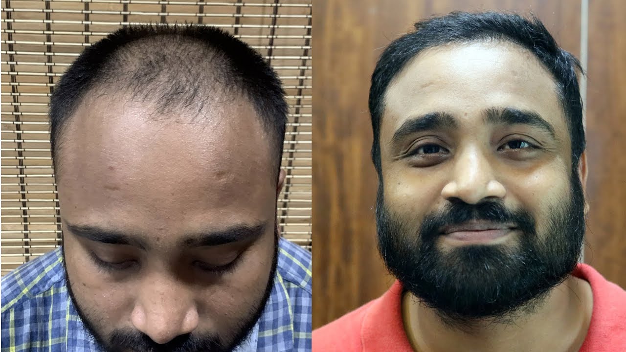 Hair Transplant In India Hair Transplant Before After Youtube youtube