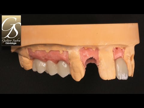 Restauração provisória - Método CAD-CAM - YouTube