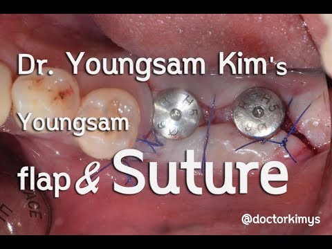 Dr. Youngsam Kim&amp;#39;s suturing technique for dental implants