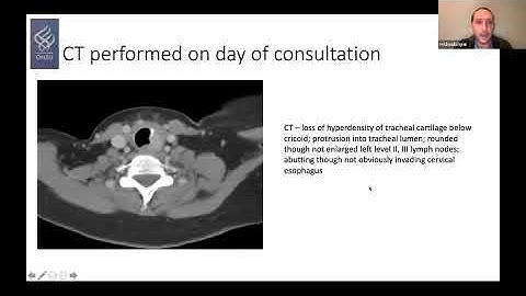 AHNS Virtual Tumor Board - Thyroid Cancers: The Good, the Bad, the Ugly
