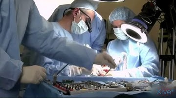 Xive™ Immediate loading in the edentulous mandible | Dentsply Sirona