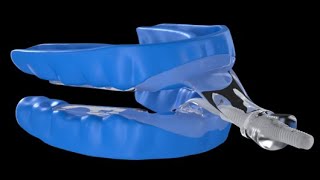 flexTAP Presentation