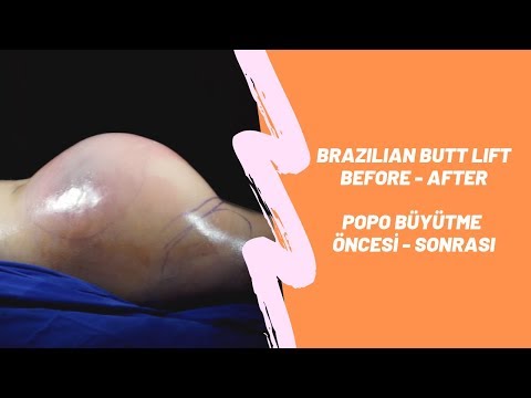 Brezilya Poposu Sonuç | Brazilian Butt Result | Flora Clinic 2019