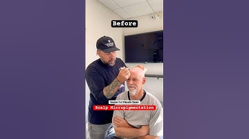 Session 2 of 3 Results Shown #smp #scalpmicropigmentation #hairlosstreatment #smptraining #edmonton