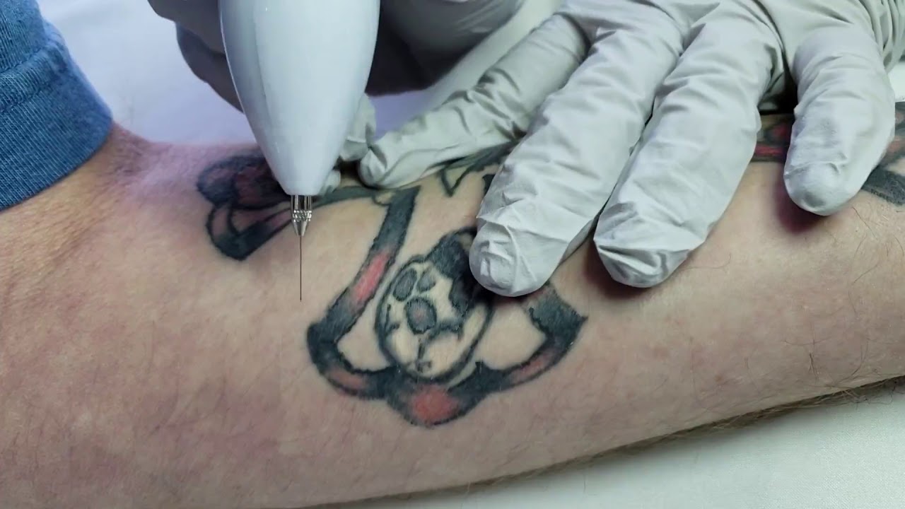 Tattoo Removal w RF Machine YouTube