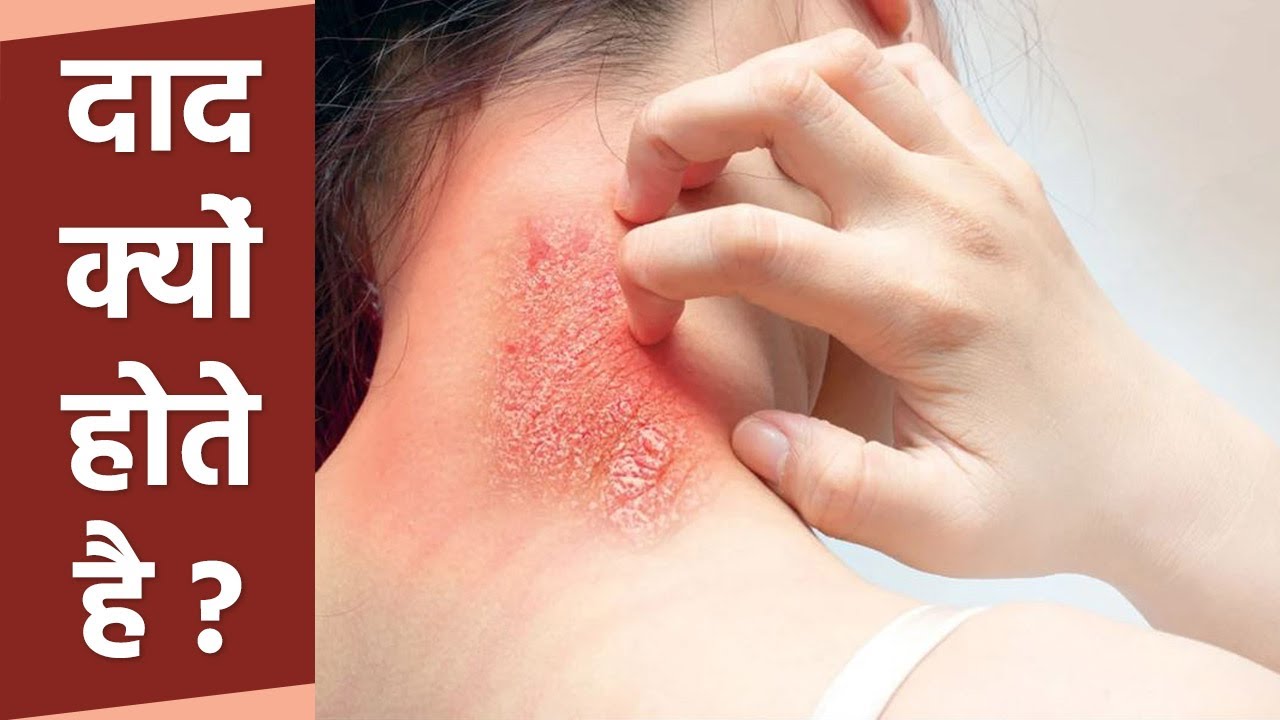 How long should we take itraconazole to get rid of ringworm? - Quora