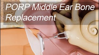 Malleus & Incus Replacement - Partial Ossicular Replacement Prosthesis (PORP) for Hearing Loss