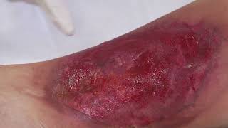 Venous Ulcers Treatment video in spanish