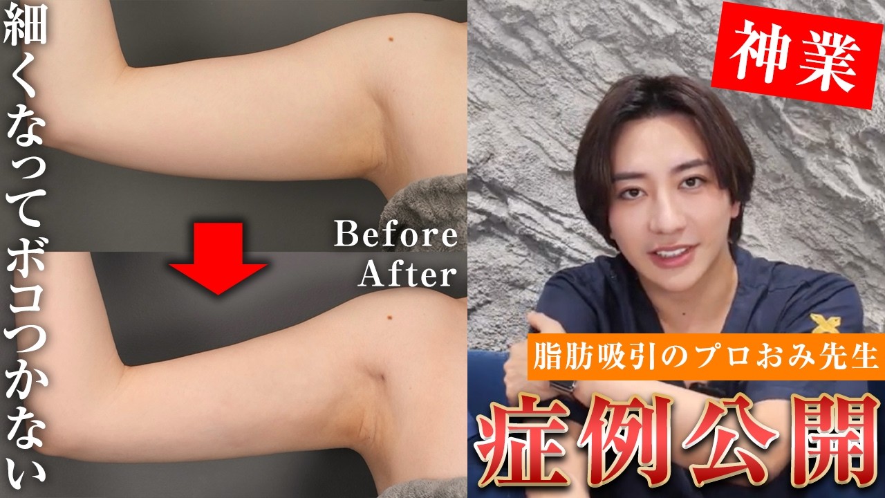 二の腕太ももボディの脂肪吸引は、おみ先生!こだわりの脂肪吸引の症例写真が凄すぎるので全てお見せします。