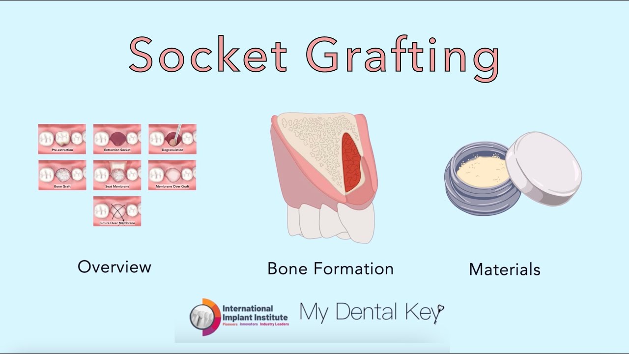 Socket Grafting - Overview, Background, Materials | My Dental Key x ...