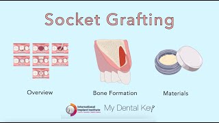 Socket Grafting - Overview, Background, Materials | My Dental Key x International Implant Institute