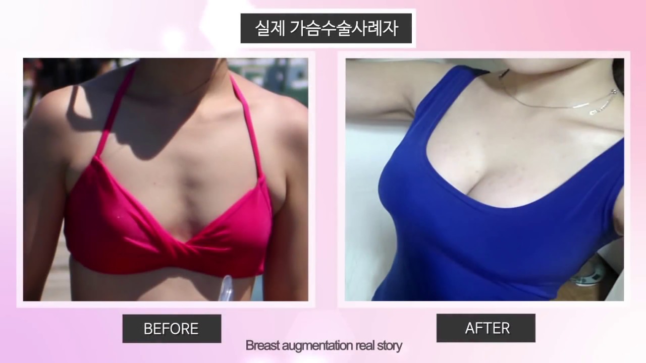 breast augmentation before and after reviews breast augmentation before and after reviews