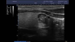 SonoScape E2 Thyroid Carcinoma ultrasound