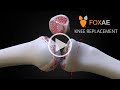 Show Knee Replacement In Real-Time | Legal Animation | Surgery Demonstration