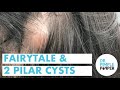 Fairytales & 2 Pilar Cysts