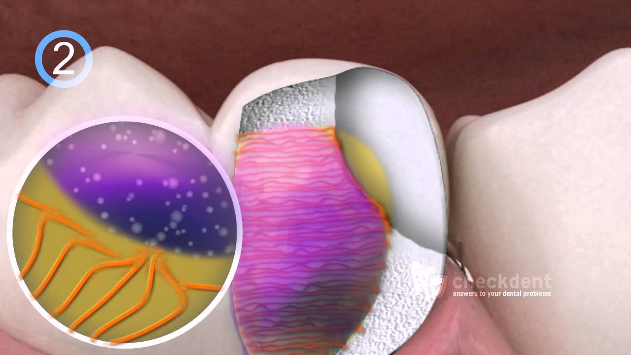 Dental Bonding of Ceramic Inlays YouTube