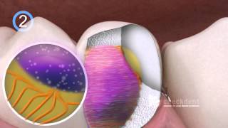 Dental Bonding Of Ceramic Inlays