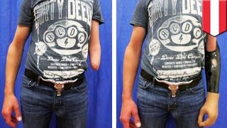 Mind-controlled prosthetic arm: new procedure allows patients to use advanced robotic arm