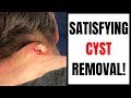 SATISFYING CYST REMOVAL!