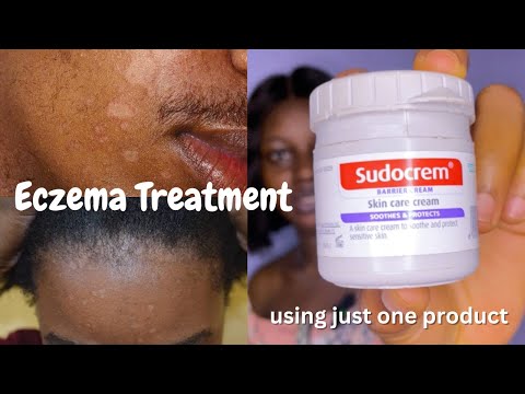 Eczema Treatment - How to Get Rid of Eczema using Sudocrem
