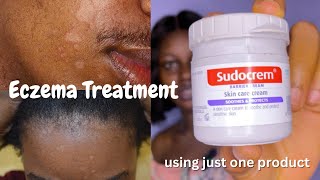 Eczema Treatment - How to Get Rid of Eczema using Sudocrem