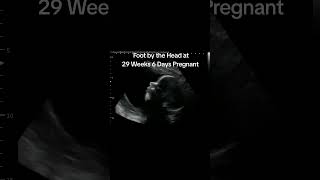 Foot by the Head on Baby Ultrasound at 29 weeks 6 days pregnant. They're so flexible! #heybabymobile