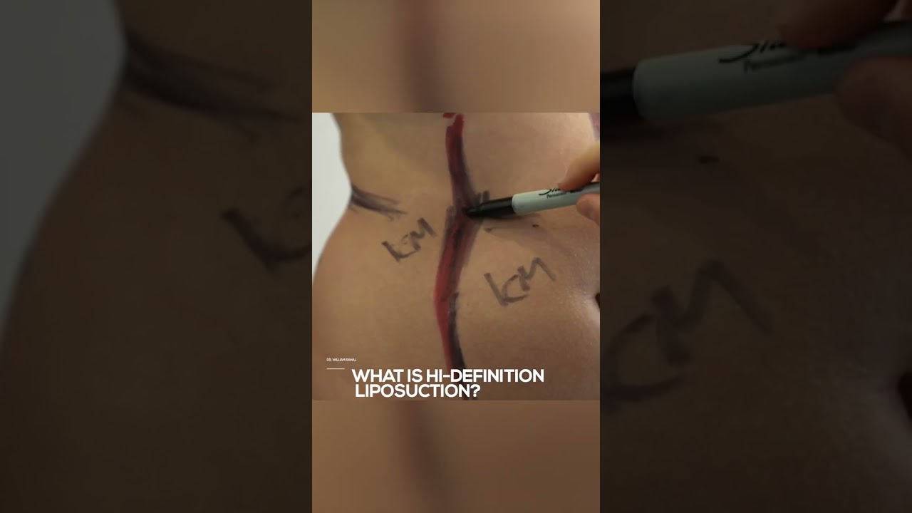 What is Hi-Definition Lipo? 